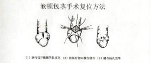 嵌顿包茎