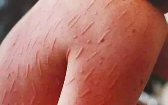 划痕性荨麻疹