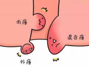 炎性外痔疮5,血栓外痔因其痔疮形体小,血管破损,血块凝结成血栓而命名