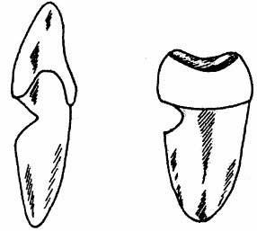 楔缺,全称楔形缺损,是指牙齿的唇(颊)颈部牙齿硬组
