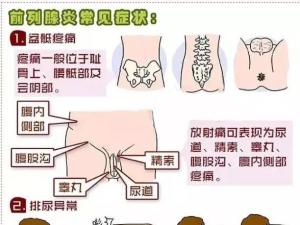 慢性前列腺炎症状