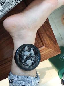 砭石温灸