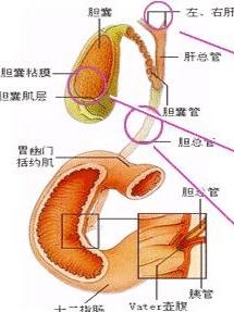 胆总管结石