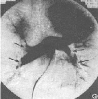 脂肪栓塞综合征