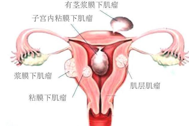 子宫肌瘤 搜狗百科