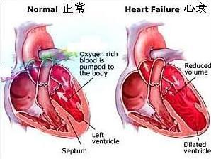 心力衰竭