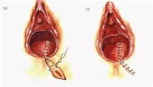 会阴撕裂