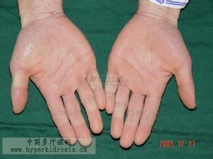 自发性多汗症