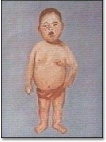 先天性甲状腺功能减低症患儿