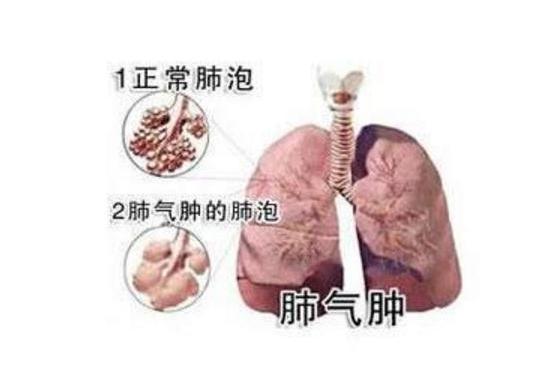 肺气肿 搜狗百科 肺气肿 搜狗百科