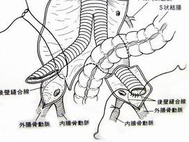 先天性冠状动脉瘘