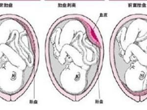 前置胎盘