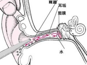 清理耳道简图