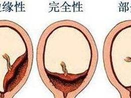 前置胎盘