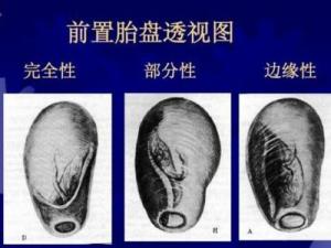 前置胎盘