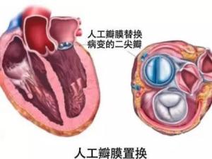 心脏瓣膜手术