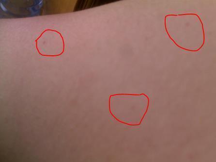 皮下出血点_搜狗百科