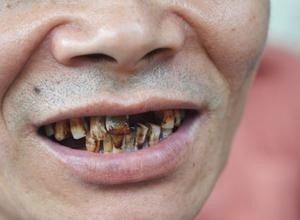 牙齿呈棕黑色 - 搜狗百科