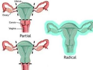 子宫切除示意图图片