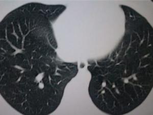 陈旧性肺结核