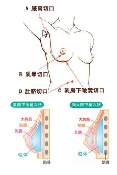 假体隆胸示意图