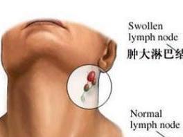淋巴结发炎