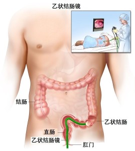 乙状结肠