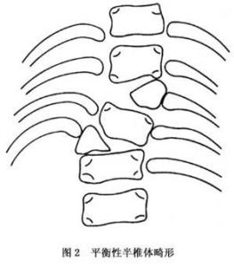 平衡性半椎体畸形