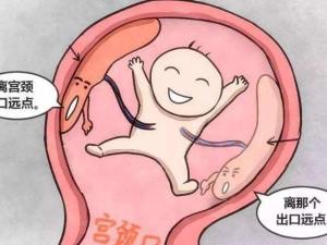 前置胎盘