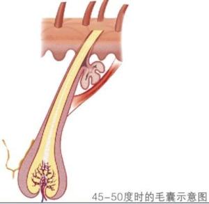 冰点脱毛机理