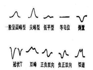 小儿心电图t波改变图片