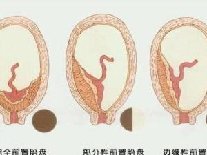 完全性前置胎盘图解图片