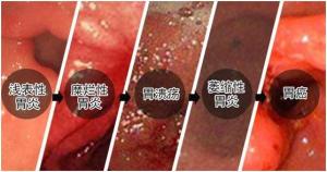 慢性非萎缩性胃炎