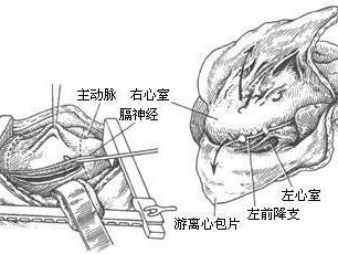 急性特发性心包炎