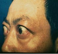 浸润性突眼