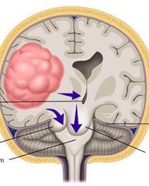 脑疝的部位图片图片