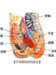子宫腺肌症
