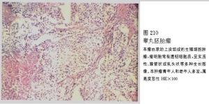 睾丸胚胎瘤