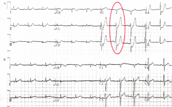 心电图T波改变