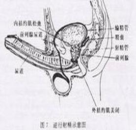 逆行射精