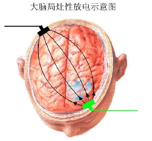 如何防止大脑放电 0