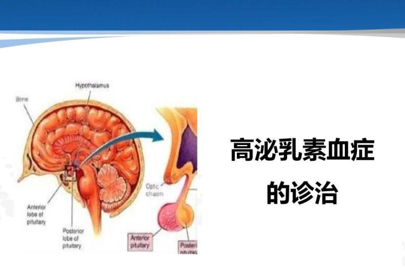 高泌乳素血症 搜狗百科