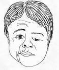 面神经炎