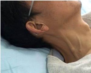 肝颈静脉回流征