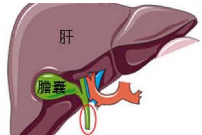 胆囊炎 搜狗百科