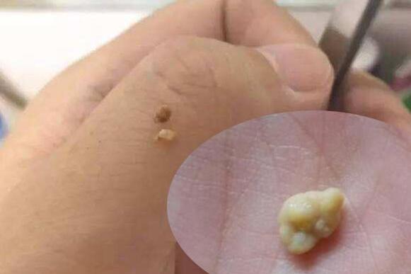 扁桃体结石 搜狗百科