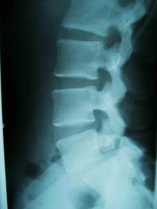 腰椎第二第三节增生