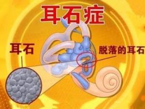 耳石症