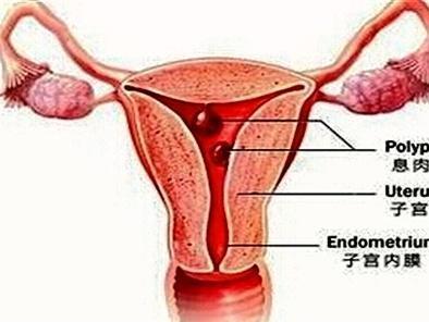 子宫内膜息肉 搜狗百科