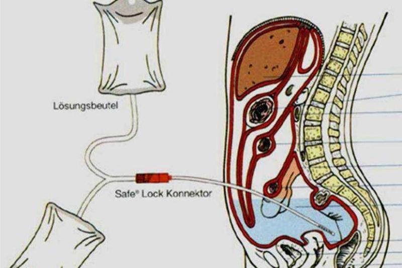腹膜透析 搜狗百科